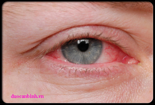 Các nguyên nhân gây viêm nhiễm tại mắt 
